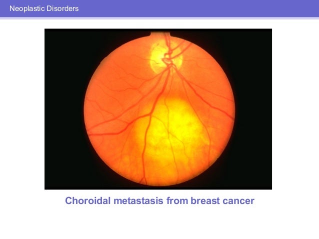 ocular inflamitory disease and breast cancer Daphne rosan big tits